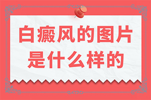 白癜风应做哪些检查？身体上有白斑是怎么回事-病因有什么