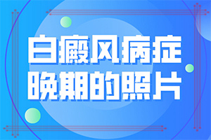 白癞癜风是什么引起的,哪些缘由导致(分析什么原因导致)