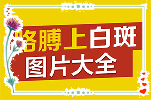 白片风的得病原因是什么(病情加重是因为什么)-身上得白斑怎么回事